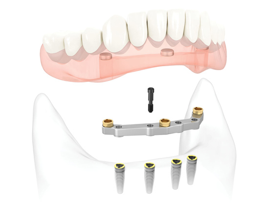 Removable-full-denture