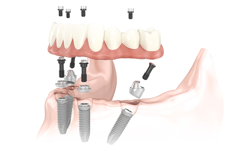 Dental Implant