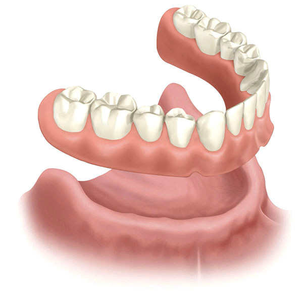 Full Denture