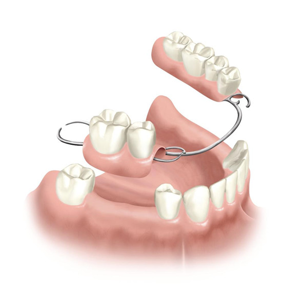 Partial-Denture